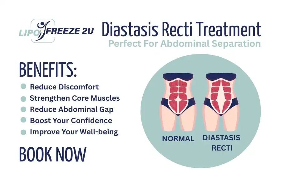 Benefits of body toning treatment Port Glasgow for Diastasis recti