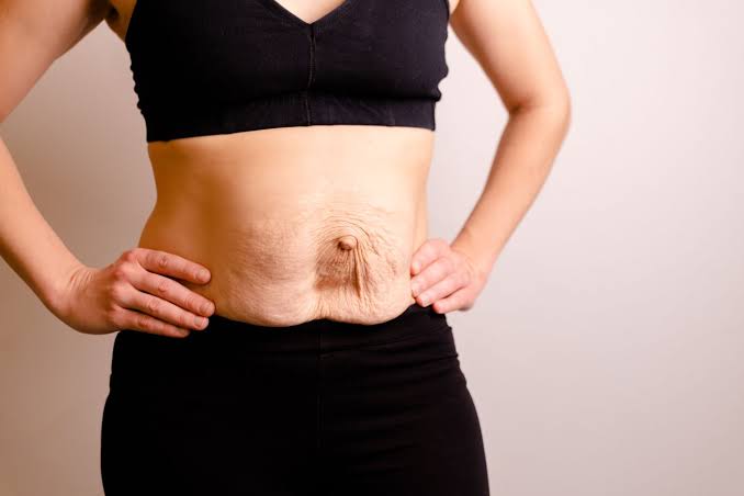 Is Surgery Really the Only Way to Repair Diastasis Recti Port Glasgow?