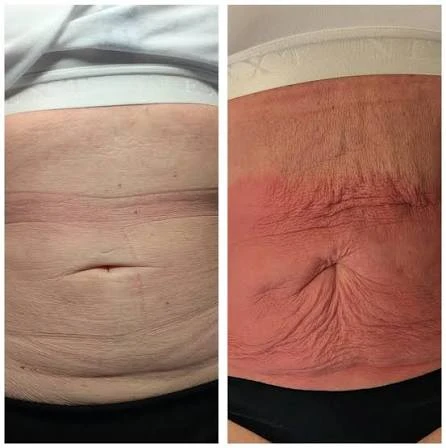 How Does RF Microneedling Improve Crepey, Thin and Uneven Skin Texture Port Glasgow?