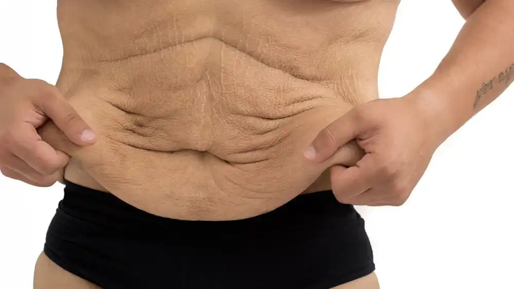 RF Microneedling for Loose Skin: How Can It Help Tighten and Reshape the Skin Port Glasgow?